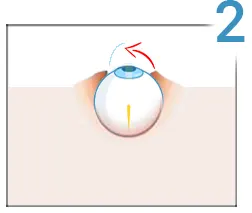 مرحله 2 لیزیک چشم