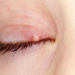 گل مژه چیست و چه عواملی باعث گل مژه می شود؟