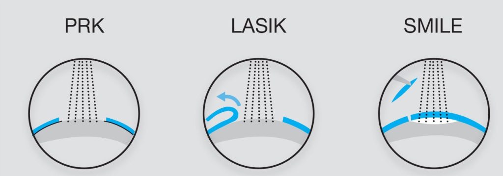 جراحی عیوب انکساری