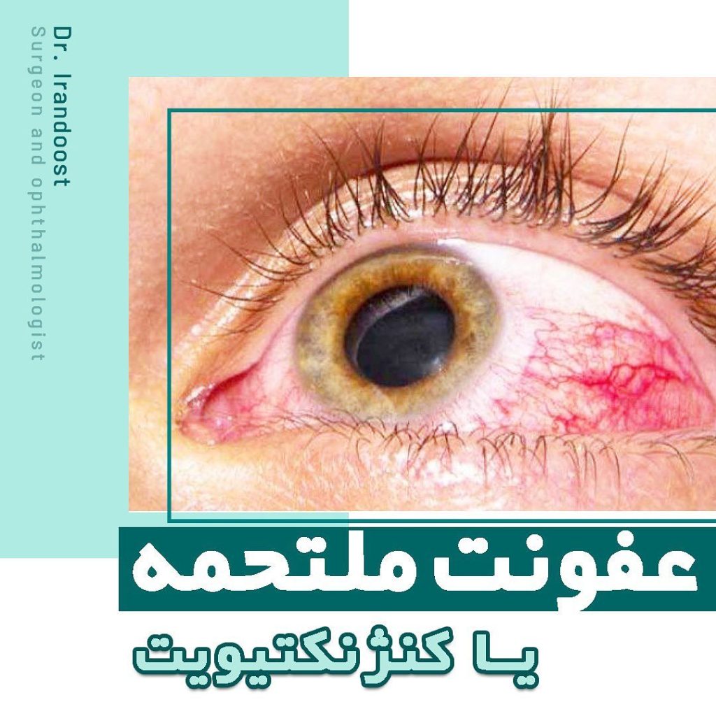 ورم ملتحمه چشم