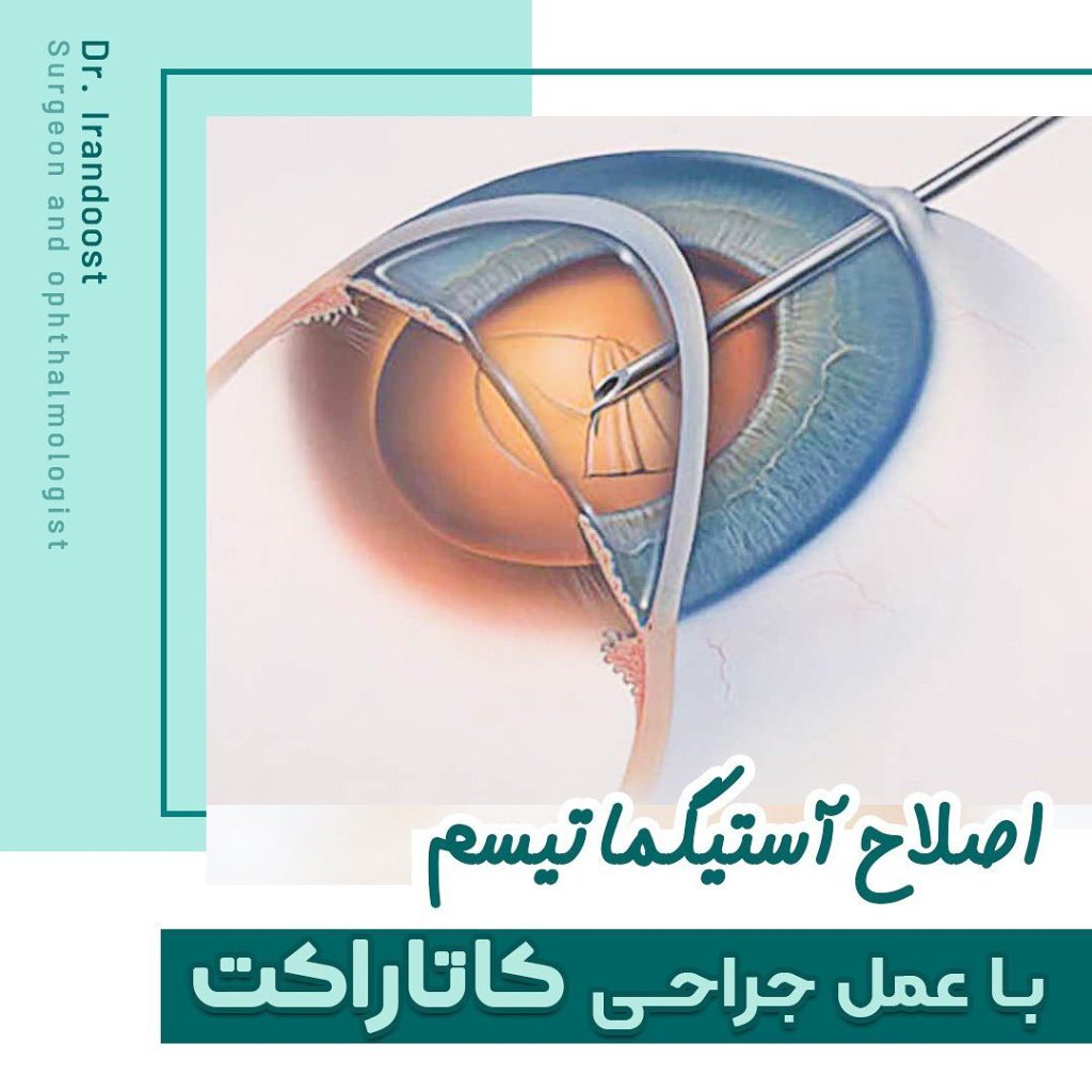 اصلاح آستیگماتیسم با جراحی کاتاراکت