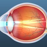 اصلاح آستیگماتیسم با جراحی کاتاراکت