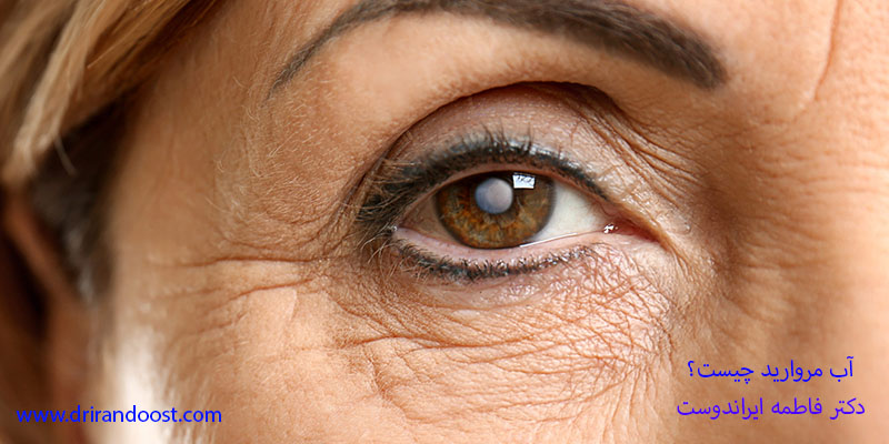 علل به وجود آمدن آب مروارید چیست؟