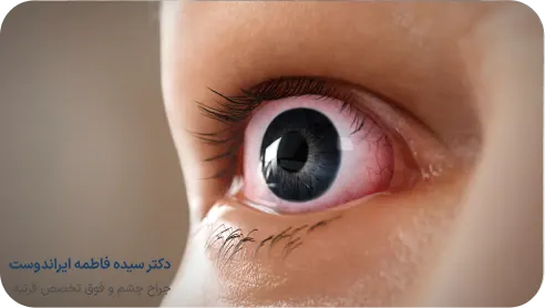 روند درمان تیروئید چشمی