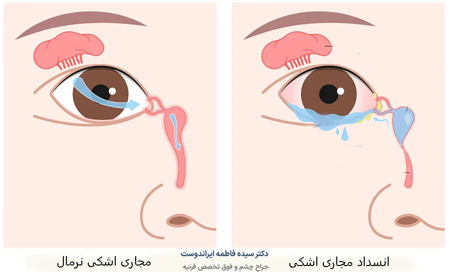 تشخیص انسداد مجاری اشکی