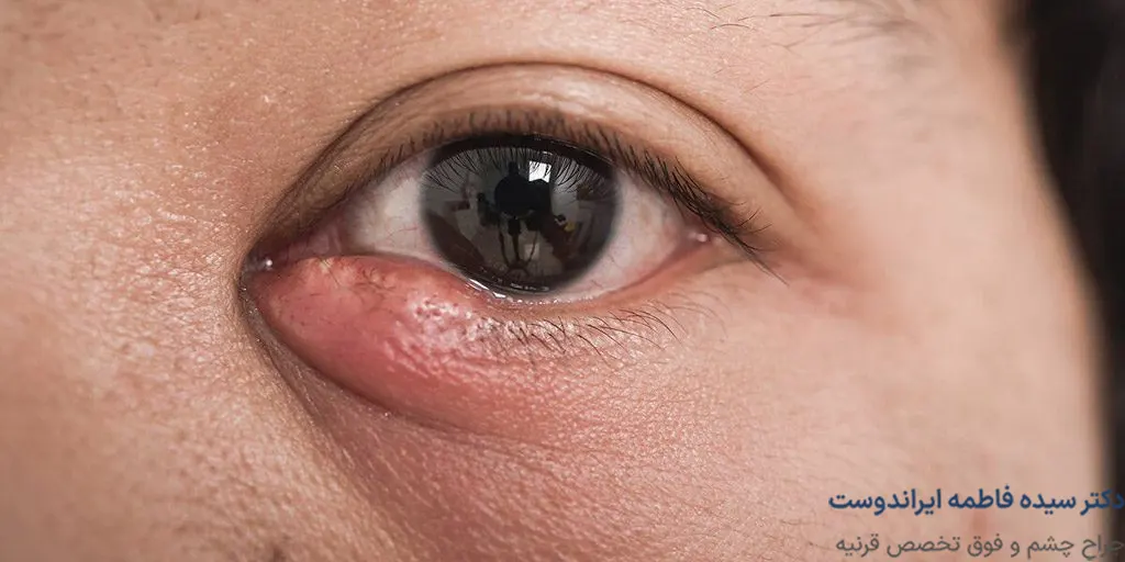علت ایجاد انسداد مجرای اشکی