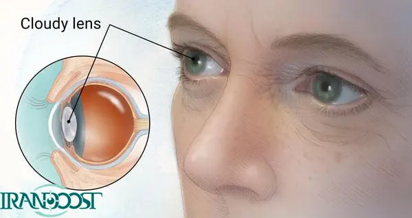 علل تاری دید بعد از عمل کاشت لنز